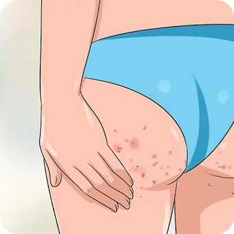 Get Rid of Acne on Buttocks