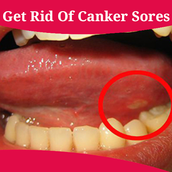 How To Get Rid Of Canker Sores