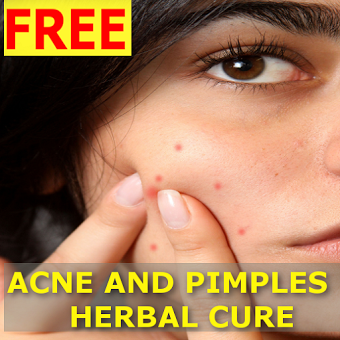 Pimple and Acne Removal Remedies : Free