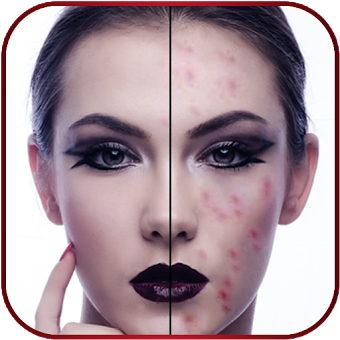 Pimple Remover & Acne Remover